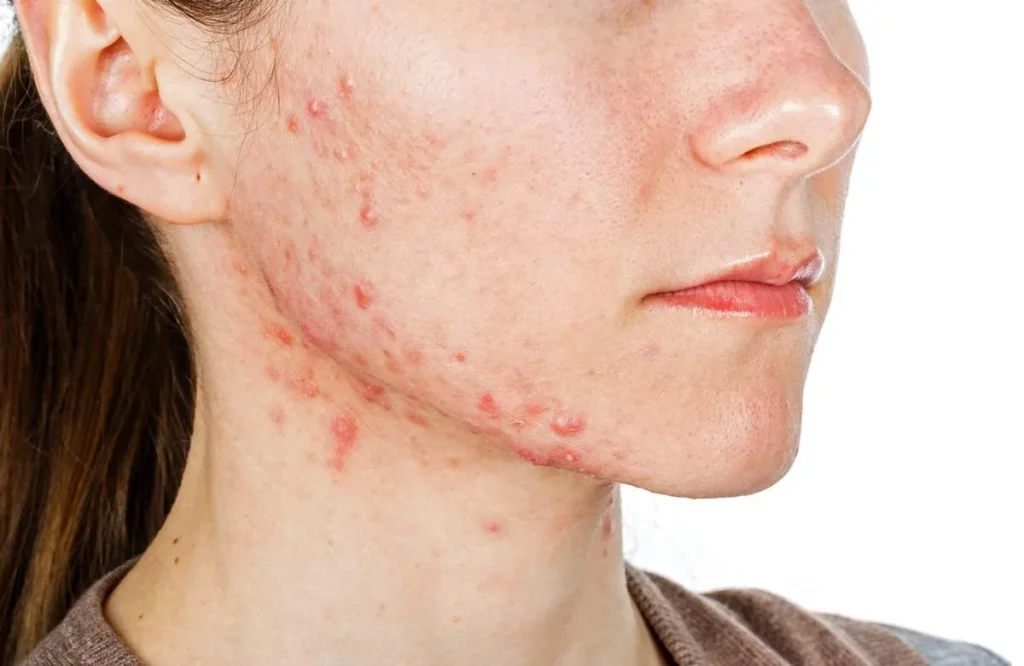 estresse e acne