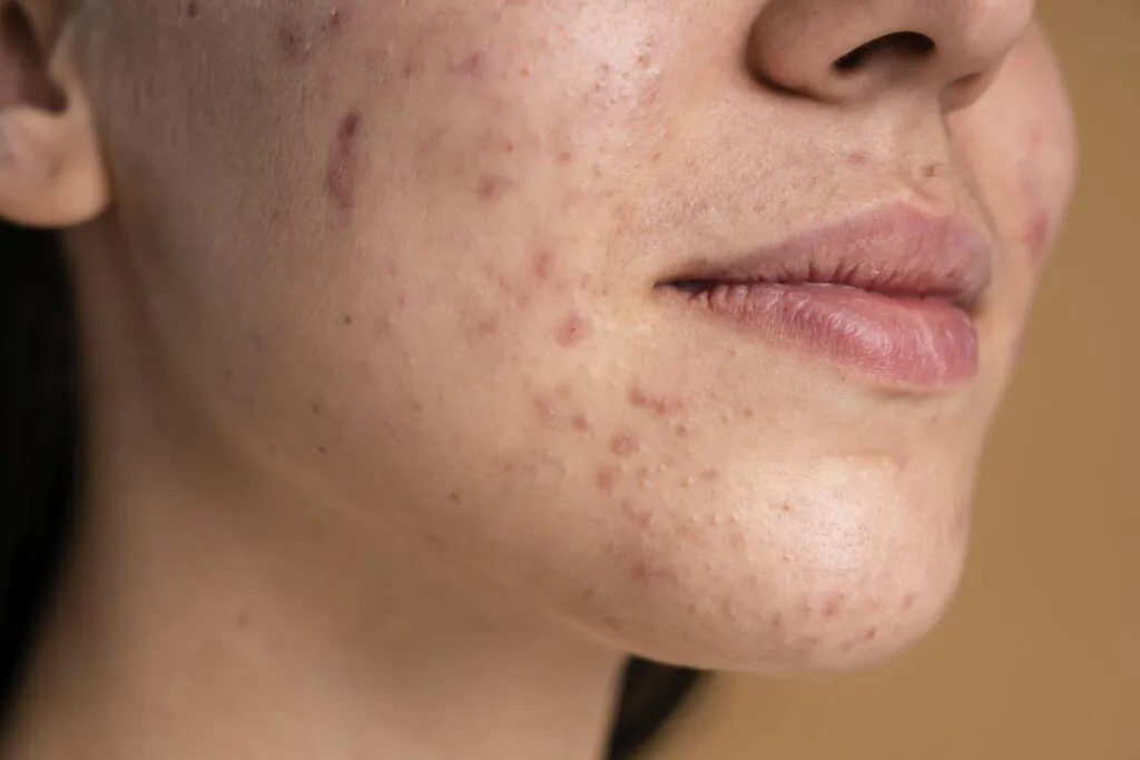 alimentação e acne