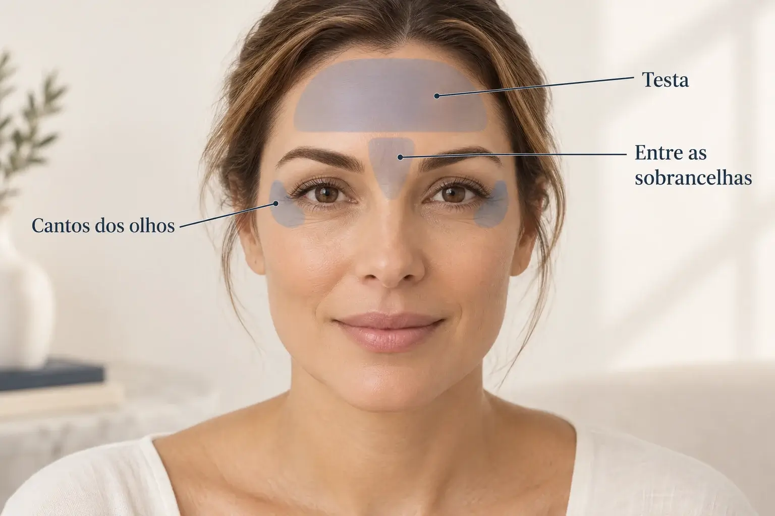 Ilustração das regiões da testa, entre as sobrancelhas e dos cantos dos olhos, frequentemente avaliadas para toxina botulínica.